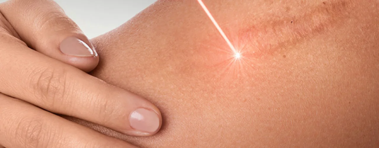 Beyond Steroids and Surgery Fractional CO2 Laser for Keloids Blog
